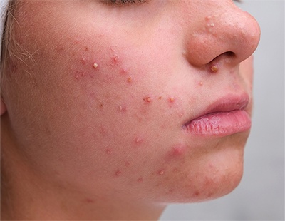 Acne Treatment in Chennai for Radiant Skin | Dr. Health Clinic